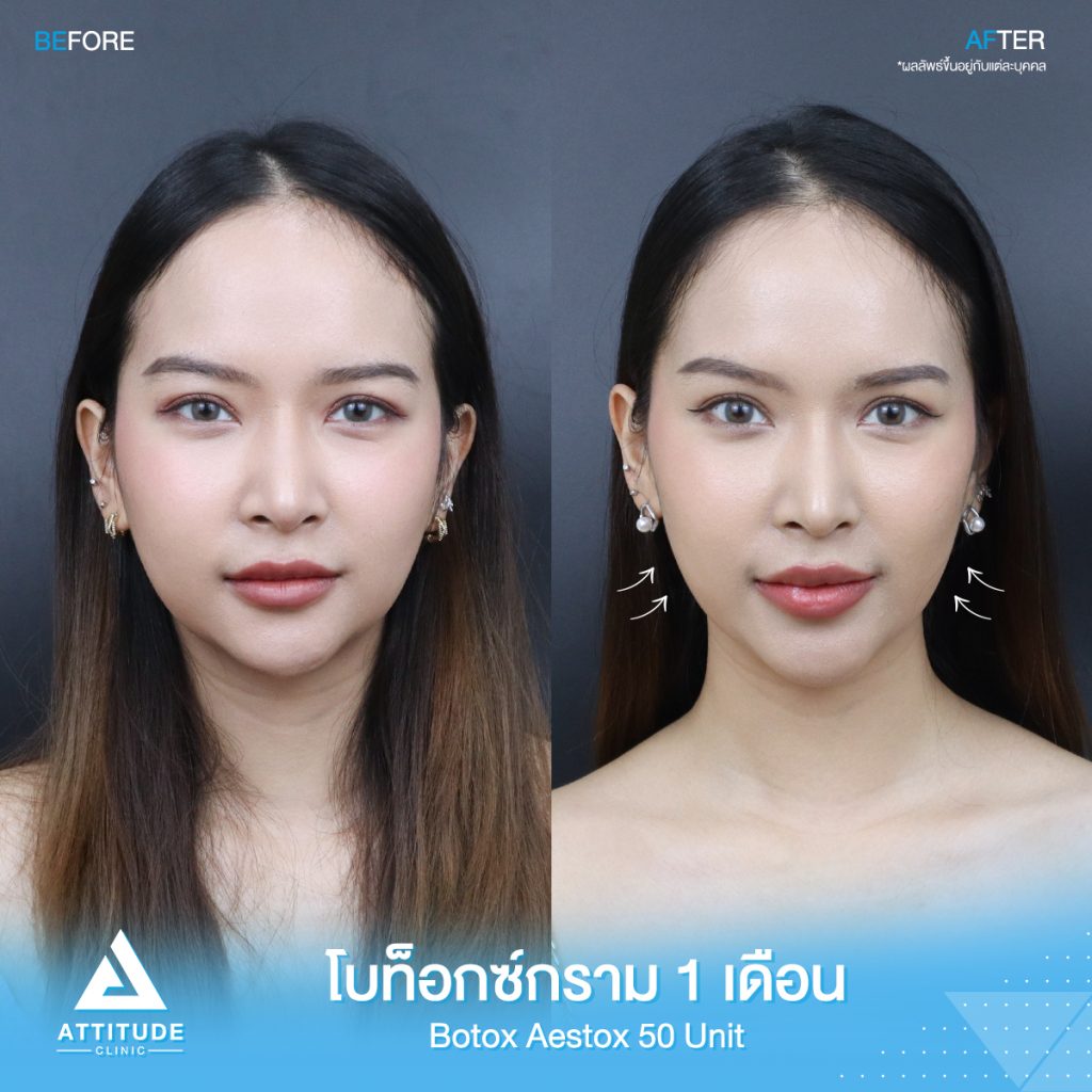 รีวิวฉีดโบท็อกซ์กราม Aestox จำนวน 50 ยูนิต ของน้องนกยูง อัพเดตหลังฉีด 1 เดือน โบท็อกซ์แท้ คุณภาพที่ Attitude Clinic