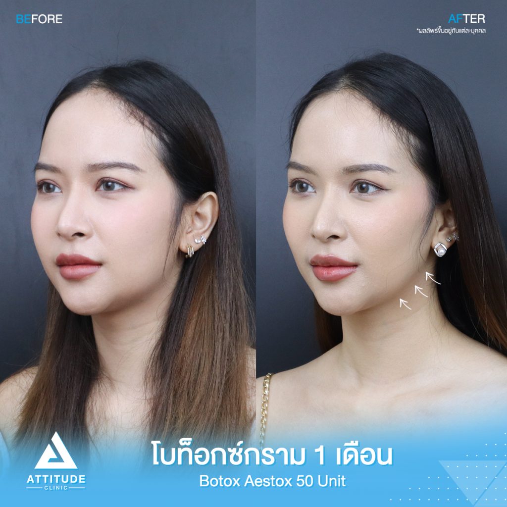 รีวิวฉีดโบท็อกซ์กราม Aestox จำนวน 50 ยูนิต ของน้องนกยูง อัพเดตหลังฉีด 1 เดือน โบท็อกซ์แท้ คุณภาพที่ Attitude Clinic