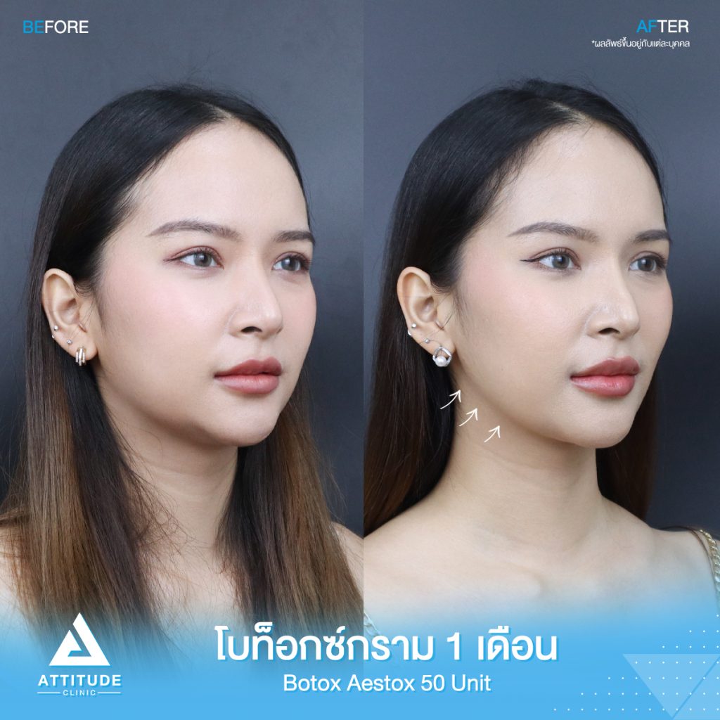 รีวิวฉีดโบท็อกซ์กราม Aestox จำนวน 50 ยูนิต ของน้องนกยูง อัพเดตหลังฉีด 1 เดือน โบท็อกซ์แท้ คุณภาพที่ Attitude Clinic