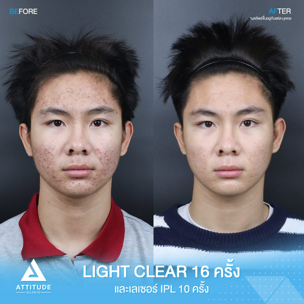 รีวิวรักษาสิวครบวงจร น้องออโต้ โปรแกรม Light Clear ด้วยการฉายแสง 7 ขั้นตอน จำนวน 16 ครั้ง และ เลเซอร์หน้าใส Cellec V IPL จำนวน 10 ครั้ง