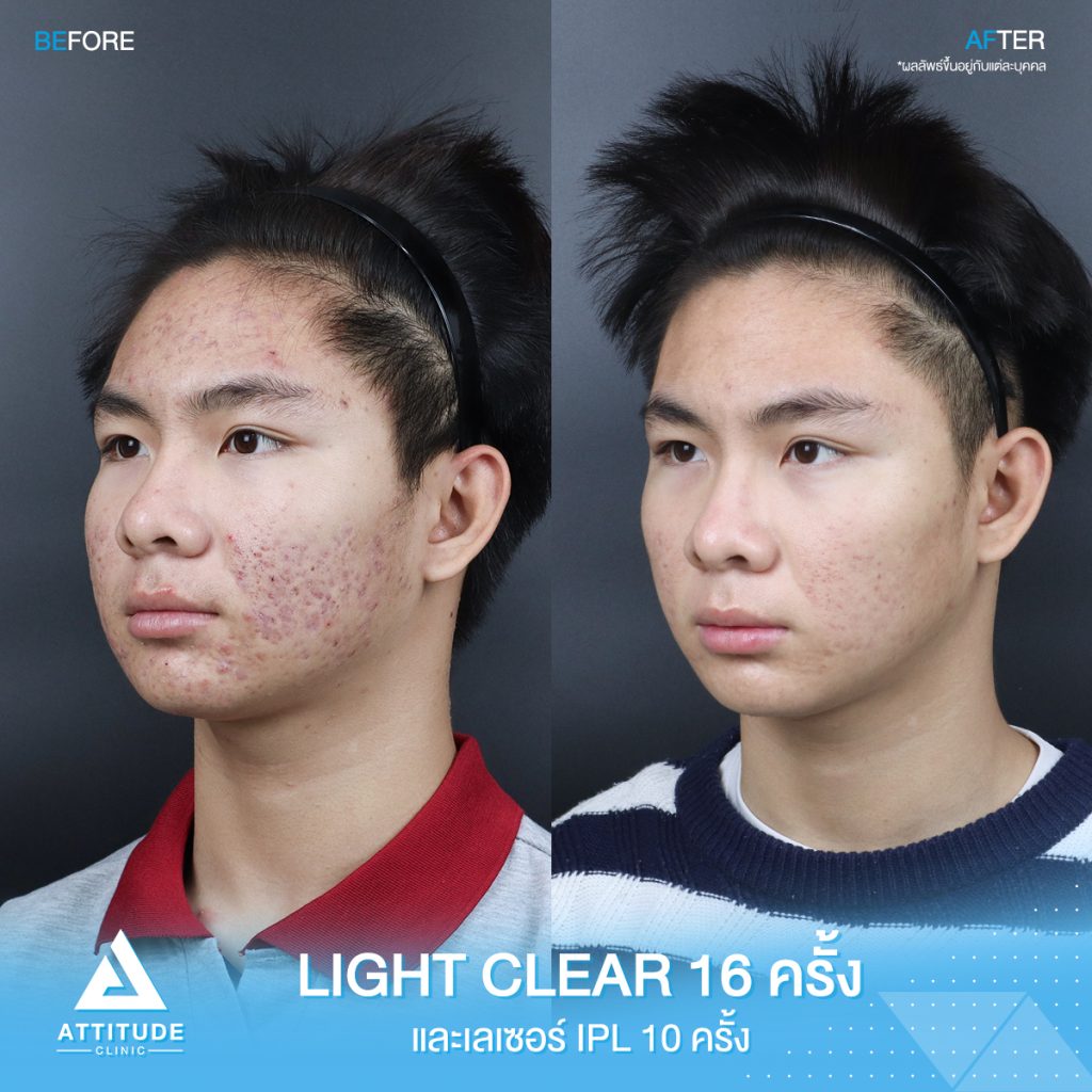 รีวิวรักษาสิวครบวงจร น้องออโต้ โปรแกรม Light Clear ด้วยการฉายแสง 7 ขั้นตอน จำนวน 16 ครั้ง และ เลเซอร์หน้าใส Cellec V IPL จำนวน 10 ครั้ง