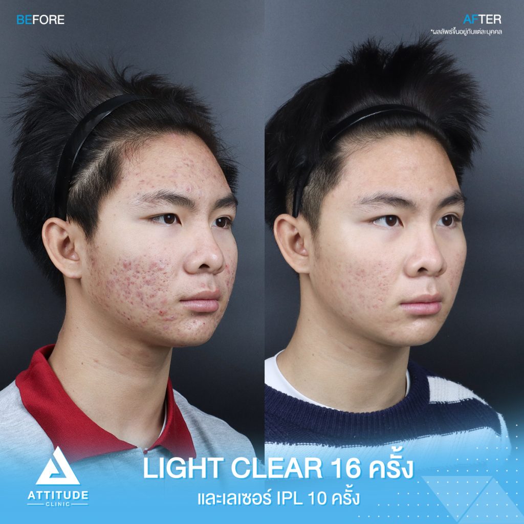 รีวิวรักษาสิวครบวงจร น้องออโต้ โปรแกรม Light Clear ด้วยการฉายแสง 7 ขั้นตอน จำนวน 16 ครั้ง และ เลเซอร์หน้าใส Cellec V IPL จำนวน 10 ครั้ง