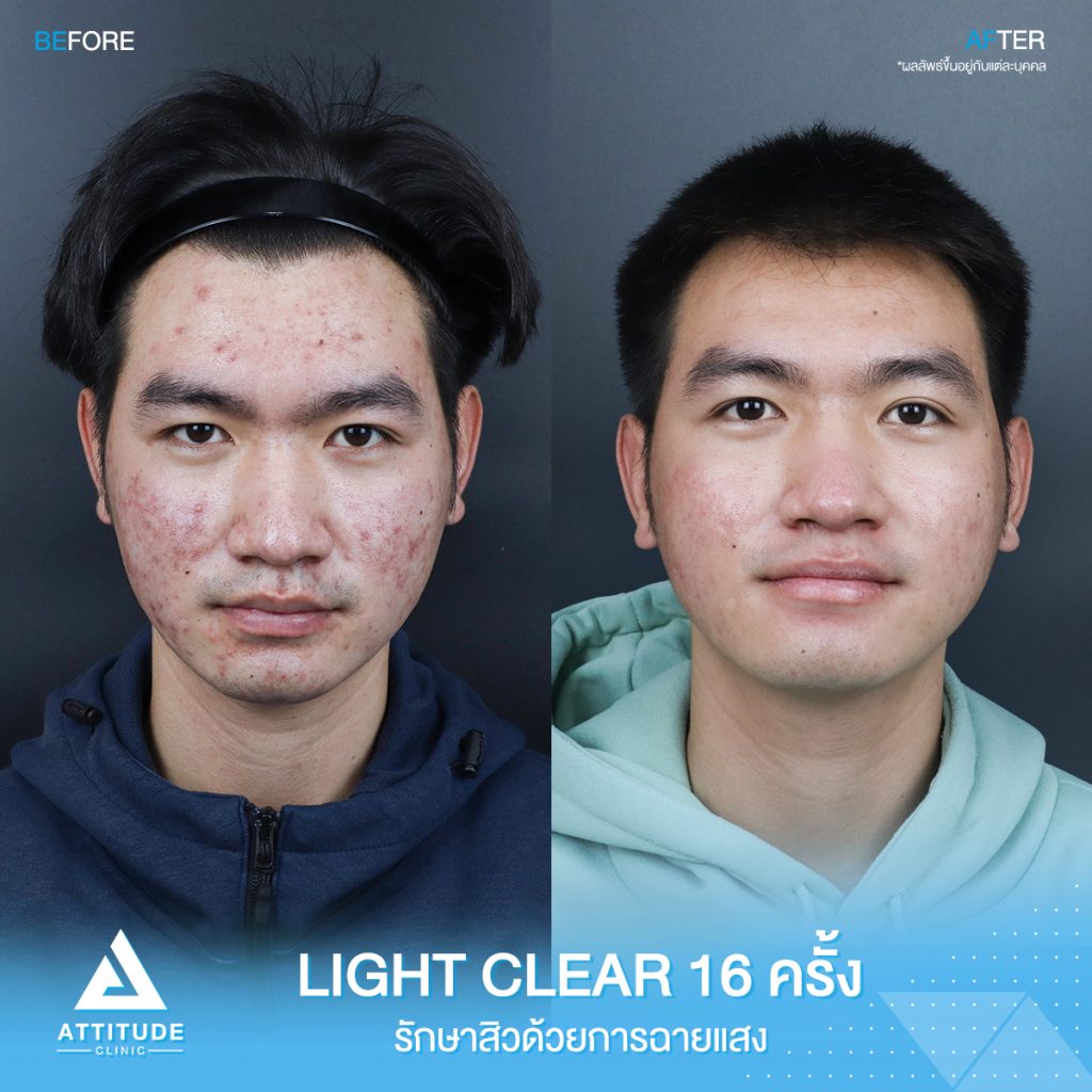 รีวิวรักษาสิวครบวงจร น้องกันต์ศักดิ์ โปรแกรม Light Clear 7 ขั้นตอน จำนวน 16 ครั้ง ที่มีปัญหาสิว รอยสิวจัดเต็ม จนตอนนี้หน้าใสขึ้น ผิวเรียบเนียนมั่นใจสุดๆ 