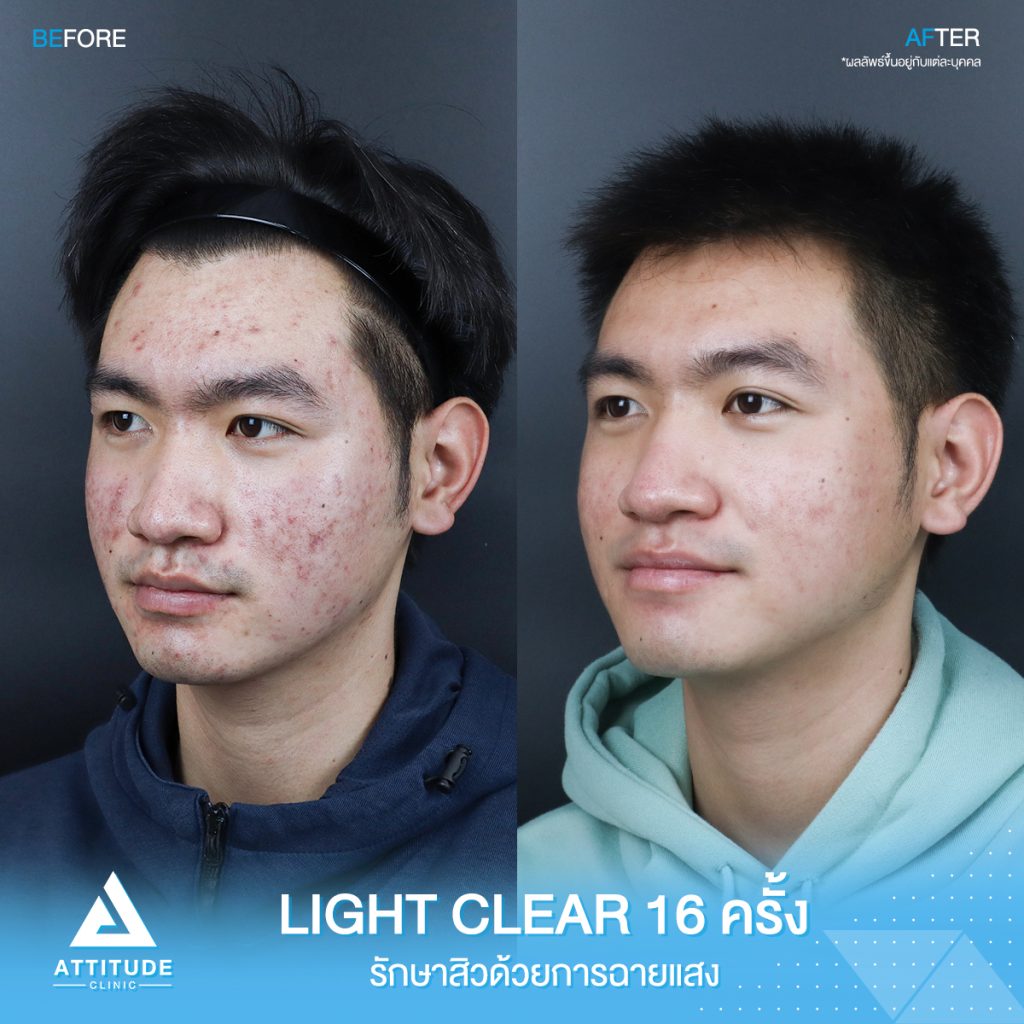 รีวิวรักษาสิวครบวงจร น้องกันต์ศักดิ์ โปรแกรม Light Clear 7 ขั้นตอน จำนวน 16 ครั้ง ที่มีปัญหาสิว รอยสิวจัดเต็ม จนตอนนี้หน้าใสขึ้น ผิวเรียบเนียนมั่นใจสุดๆ