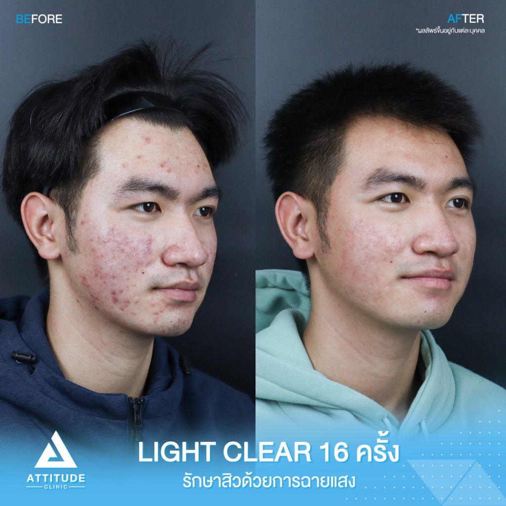 รีวิวรักษาสิวครบวงจร น้องกันต์ศักดิ์ โปรแกรม Light Clear 7 ขั้นตอน จำนวน 16 ครั้ง ที่มีปัญหาสิว รอยสิวจัดเต็ม จนตอนนี้หน้าใสขึ้น ผิวเรียบเนียนมั่นใจสุดๆ