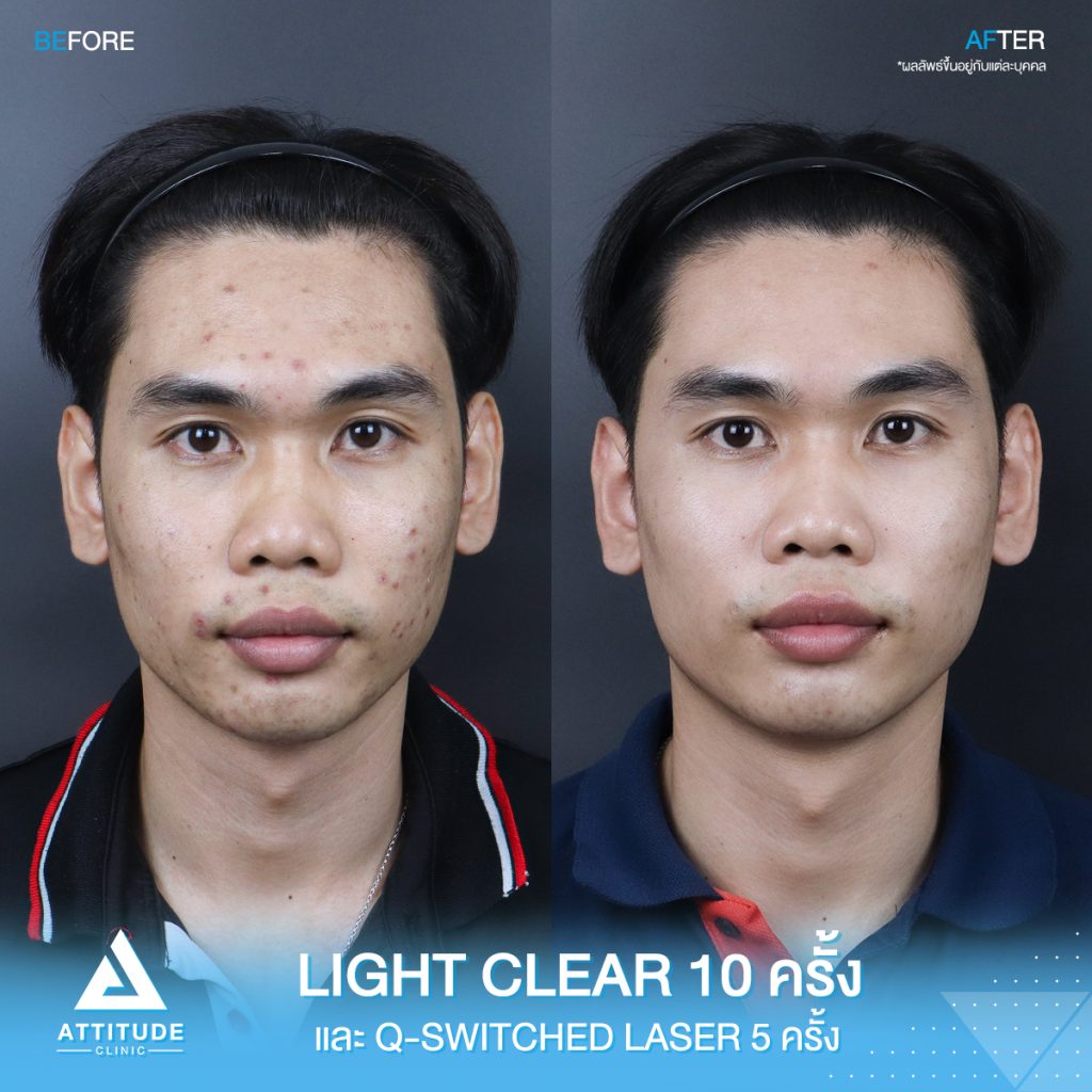 รีวิวรักษาสิวครบวงจร น้องเอฟ โปรแกรม Light Clear รักษาสิวด้วยการฉายแสง 7 ขั้นตอน จำนวน 10 ครั้ง เลเซอร์ Q-Switched ตีเม็ดสีลดจุดด่างดำ จำนวน 5 ครั้ง