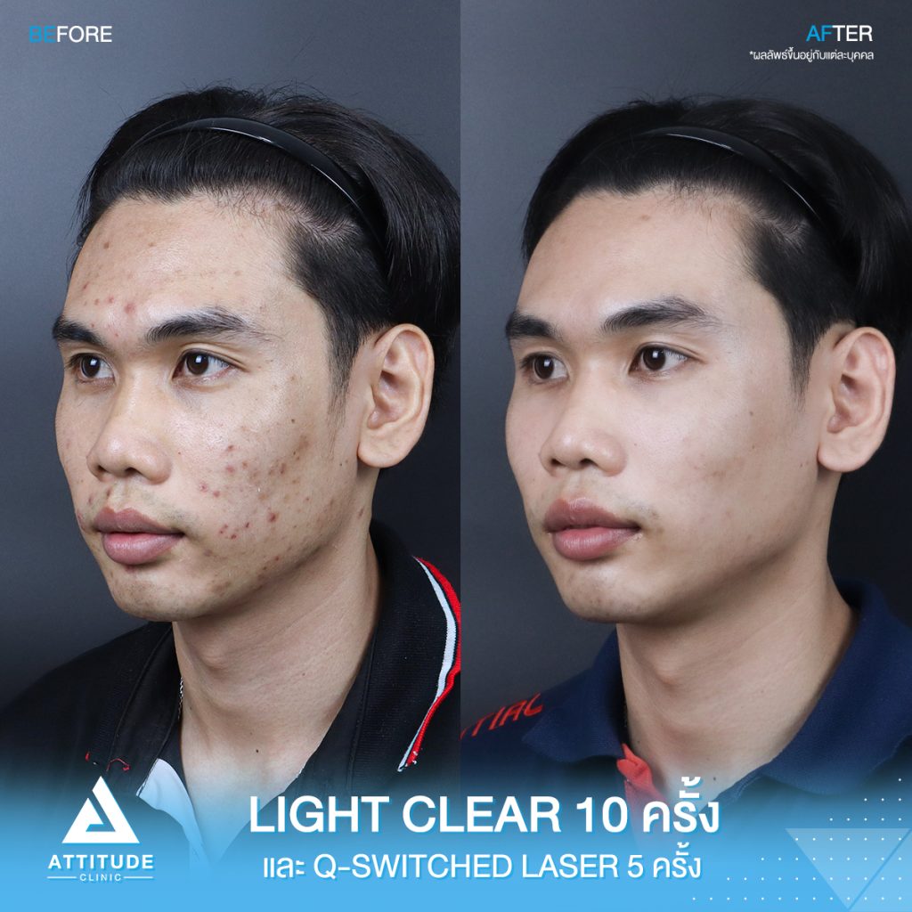 รีวิวรักษาสิวครบวงจร น้องเอฟ โปรแกรม Light Clear รักษาสิวด้วยการฉายแสง 7 ขั้นตอน จำนวน 10 ครั้ง เลเซอร์ Q-Switched ตีเม็ดสีลดจุดด่างดำ จำนวน 5 ครั้ง