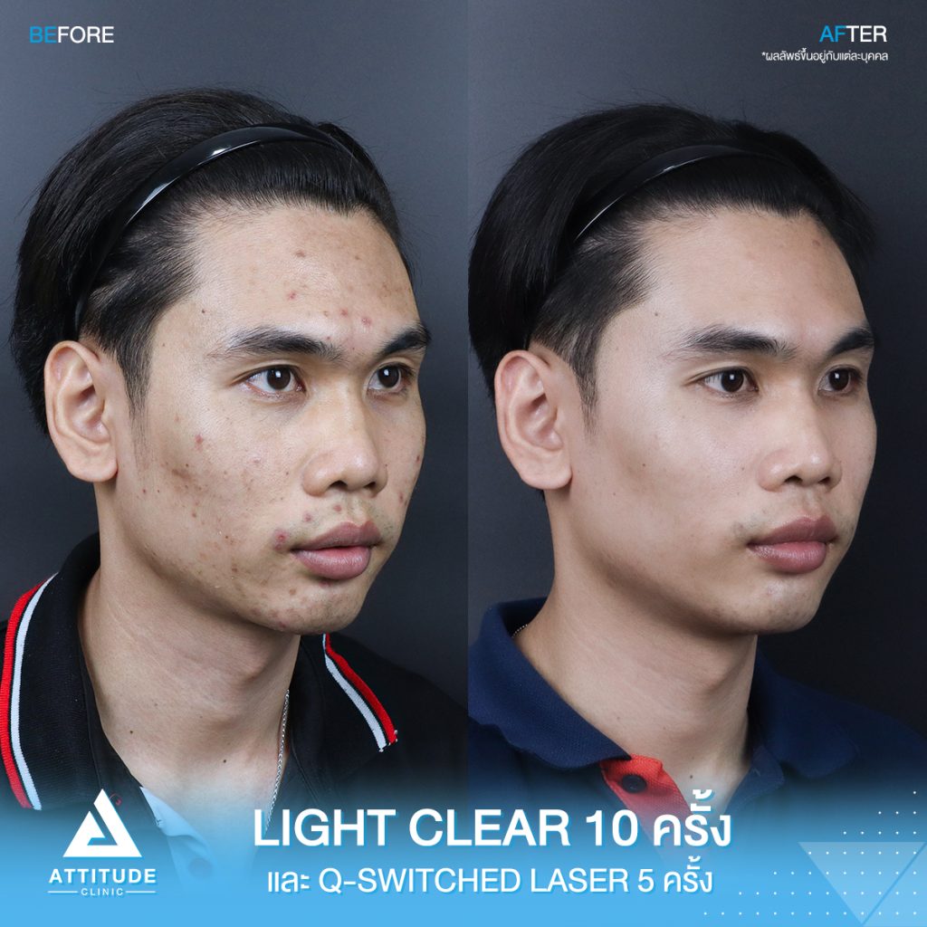 รีวิวรักษาสิวครบวงจร น้องเอฟ โปรแกรม Light Clear รักษาสิวด้วยการฉายแสง 7 ขั้นตอน จำนวน 10 ครั้ง เลเซอร์ Q-Switched ตีเม็ดสีลดจุดด่างดำ จำนวน 5 ครั้ง