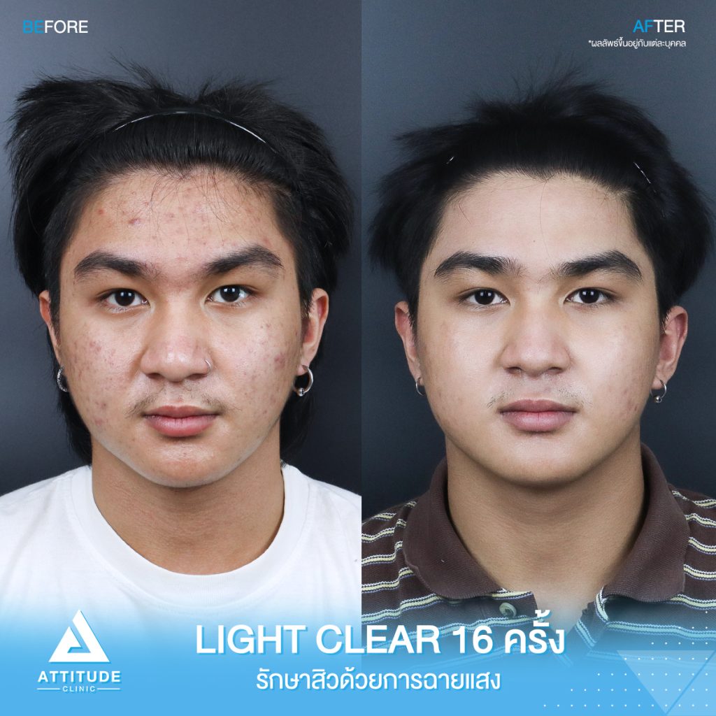 รีวิวรักษาสิวครบวงจร น้องเพชร โปรแกรม Light Clear 7 ขั้นตอน จำนวน 16 ครั้ง ที่มีปัญหาสิว รอยสิวจัดเต็ม หลังรักษาสิวตอนนี้หน้าใสวิ้ง ผิวเรียบเนียนมั่นใจสุดๆ