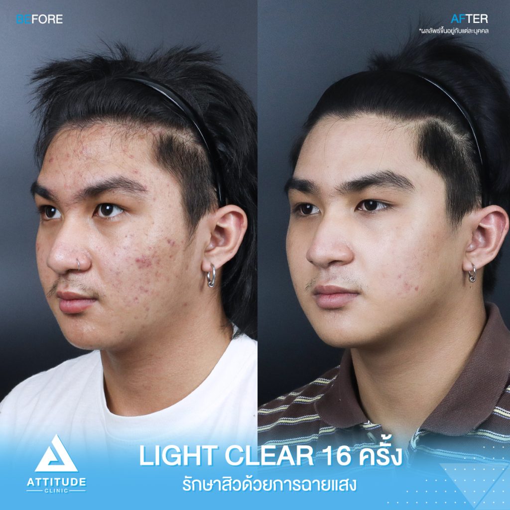 รีวิวรักษาสิวครบวงจร น้องเพชร โปรแกรม Light Clear 7 ขั้นตอน จำนวน 16 ครั้ง ที่มีปัญหาสิว รอยสิวจัดเต็ม หลังรักษาสิวตอนนี้หน้าใสวิ้ง ผิวเรียบเนียนมั่นใจสุดๆ