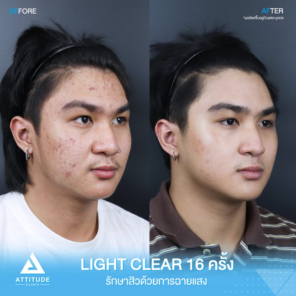 รีวิวรักษาสิวครบวงจร น้องเพชร โปรแกรม Light Clear 7 ขั้นตอน จำนวน 16 ครั้ง ที่มีปัญหาสิว รอยสิวจัดเต็ม หลังรักษาสิวตอนนี้หน้าใสวิ้ง ผิวเรียบเนียนมั่นใจสุดๆ