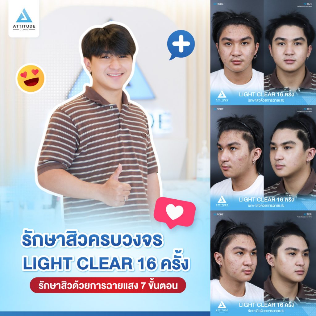 รีวิวรักษาสิวครบวงจร น้องเพชร โปรแกรม Light Clear 7 ขั้นตอน จำนวน 16 ครั้ง ที่มีปัญหาสิว รอยสิวจัดเต็ม หลังรักษาสิวตอนนี้หน้าใสวิ้ง ผิวเรียบเนียนมั่นใจสุดๆ