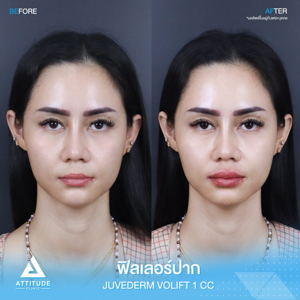 รีวิวฉีดฟิลเลอร์ปาก Juvederm Volift จำนวน 1 cc เติมเต็มปากสวยอวบอิ่มได้รูป ละมุนจนน่าจุ๊บ เข้ากับใบหน้าสุดๆ ด้วยฟิลเลอร์แท้ คุณหมอเชี่ยวชาญ ต้องที่ ???????? ?????? 