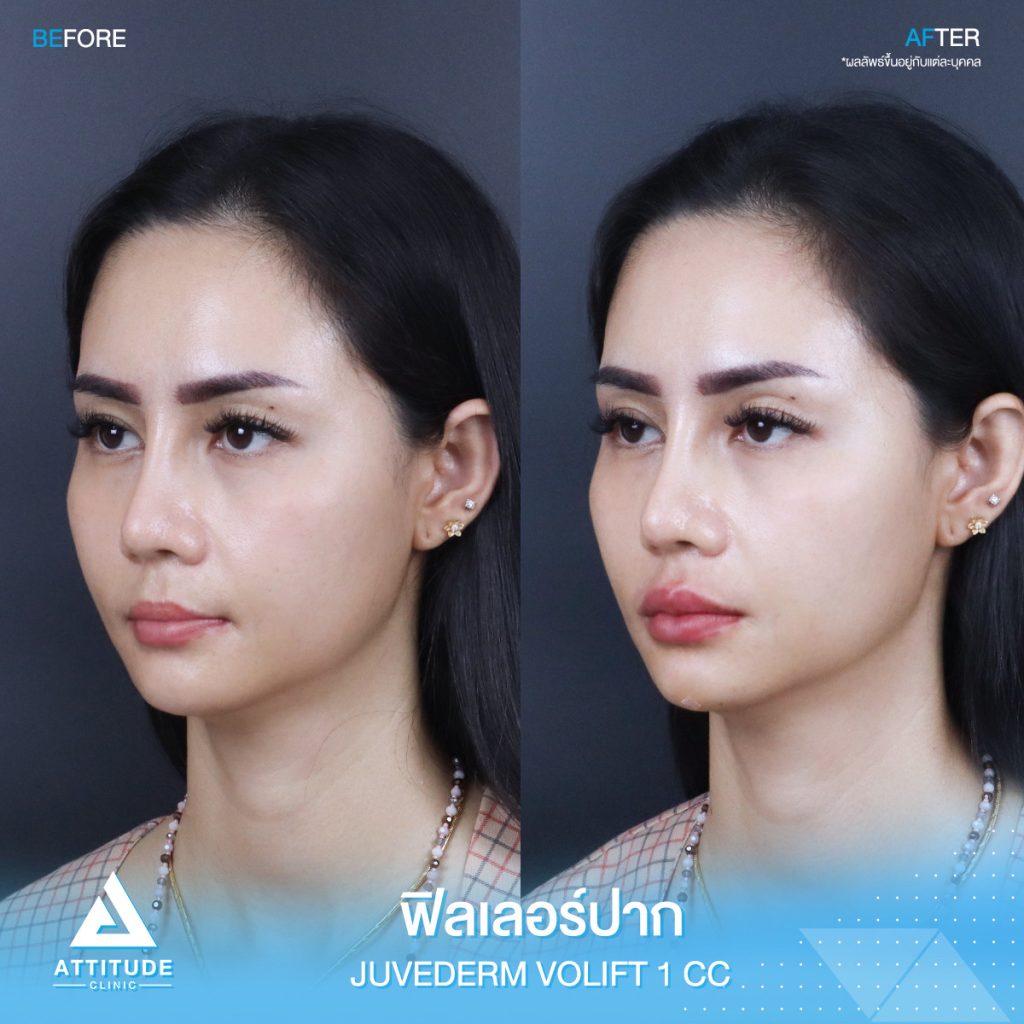 รีวิวฉีดฟิลเลอร์ปาก Juvederm Volift จำนวน 1 cc เติมเต็มปากสวยอวบอิ่มได้รูป ละมุนจนน่าจุ๊บ เข้ากับใบหน้าสุดๆ ด้วยฟิลเลอร์แท้ คุณหมอเชี่ยวชาญ ต้องที่ ???????? ??????