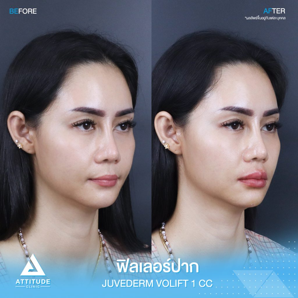 รีวิวฉีดฟิลเลอร์ปาก Juvederm Volift จำนวน 1 cc เติมเต็มปากสวยอวบอิ่มได้รูป ละมุนจนน่าจุ๊บ เข้ากับใบหน้าสุดๆ ด้วยฟิลเลอร์แท้ คุณหมอเชี่ยวชาญ ต้องที่ ???????? ??????