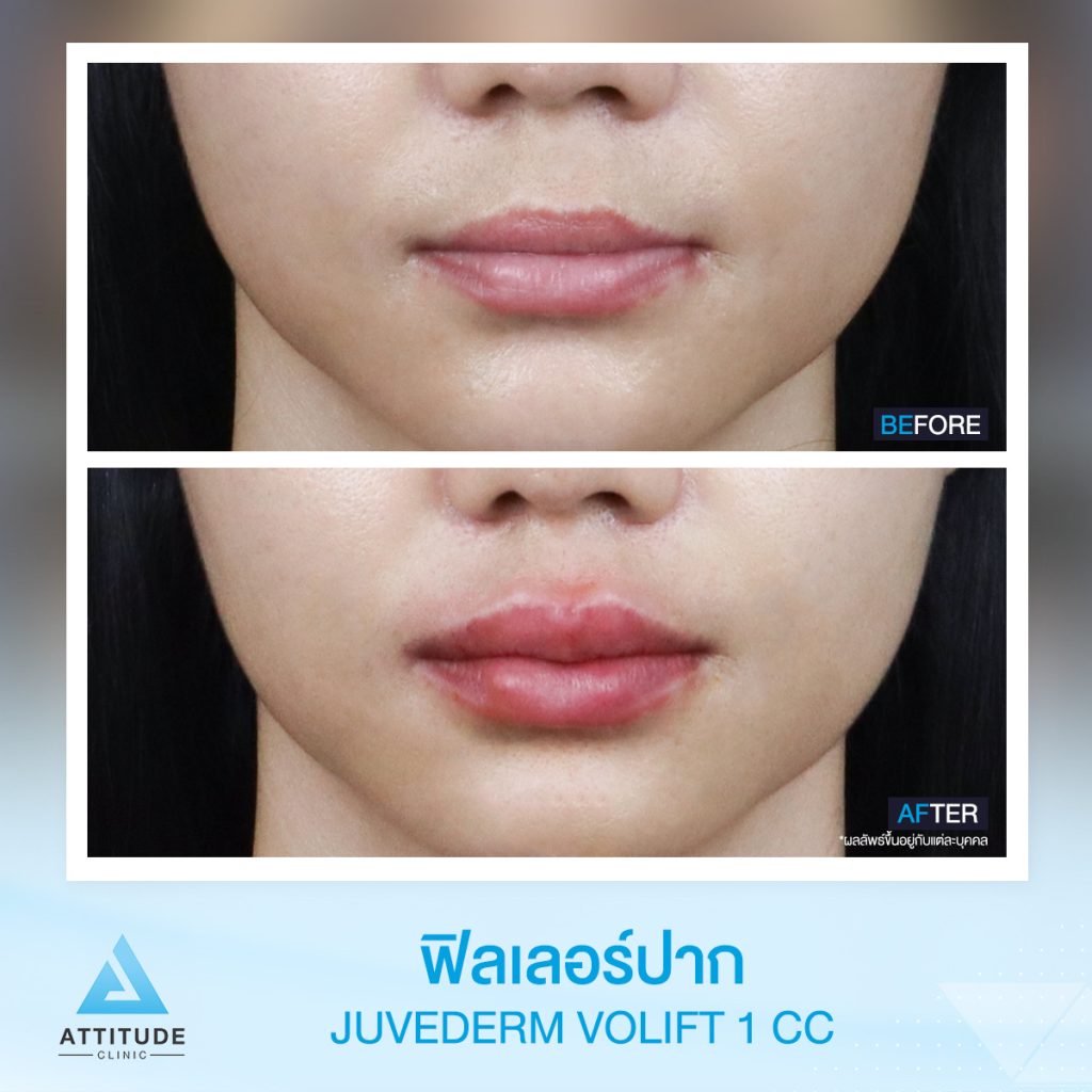 รีวิวฉีดฟิลเลอร์ปาก Juvederm Volift จำนวน 1 cc เติมเต็มปากสวยอวบอิ่มได้รูป ละมุนจนน่าจุ๊บ เข้ากับใบหน้าสุดๆ ด้วยฟิลเลอร์แท้ คุณหมอเชี่ยวชาญ ต้องที่ ???????? ??????