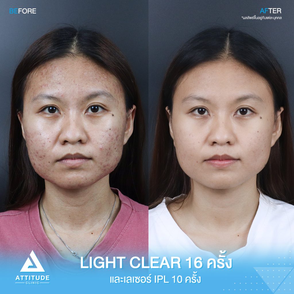 รีวิวรักษาสิว น้องอาย ผู้หญิง รีวิวรักษาสิวครบวงจร น้องอาย โปรแกรม Light Clear 7 ขั้นตอน จำนวน 16 ครั้ง เลเซอร์หน้าใส Cellec V IPL จำนวน 10 ครั้งที่มีปัญหา สิวอุดตัน สิวอักเสบ สิวแพ้ และรอยสิว