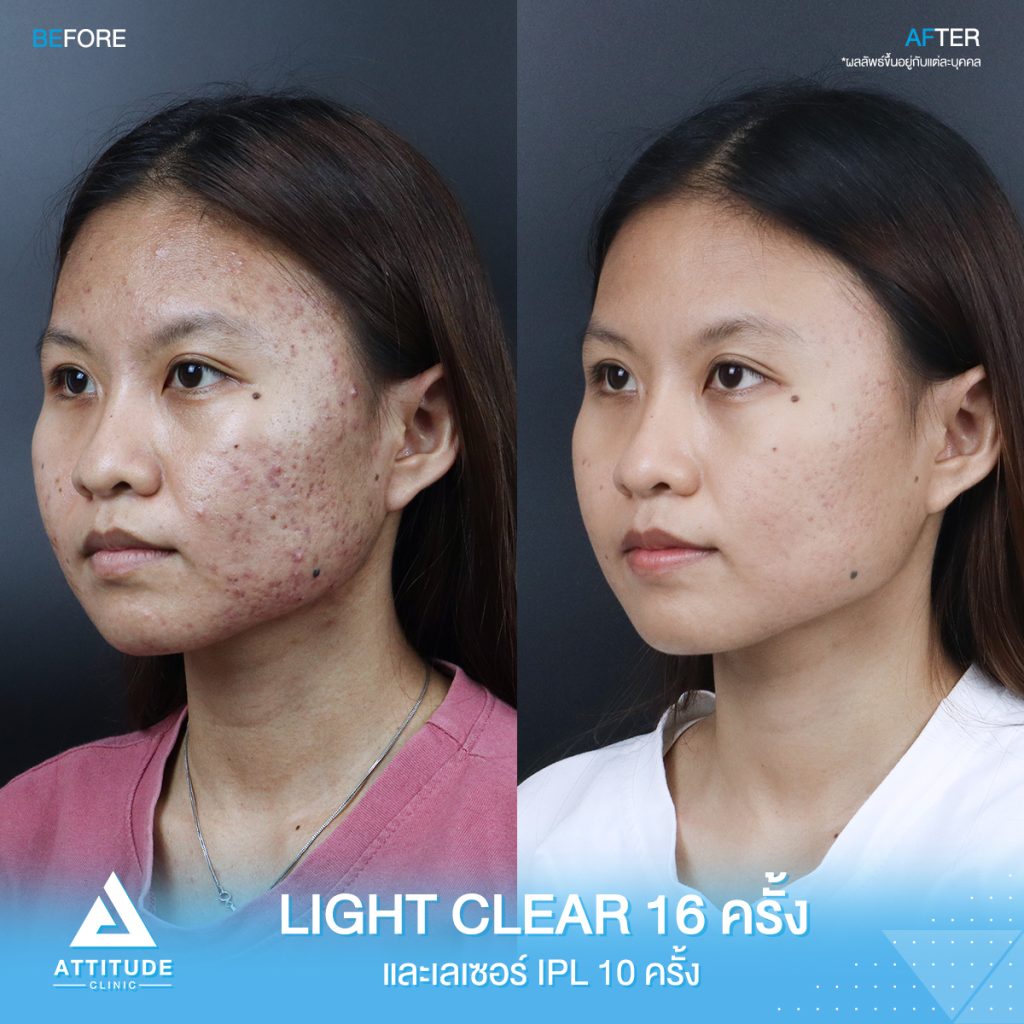 รีวิวรักษาสิว น้องอาย ผู้หญิง รีวิวรักษาสิวครบวงจร น้องอาย โปรแกรม Light Clear 7 ขั้นตอน จำนวน 16 ครั้ง เลเซอร์หน้าใส Cellec V IPL จำนวน 10 ครั้งที่มีปัญหา สิวอุดตัน สิวอักเสบ สิวแพ้ และรอยสิว