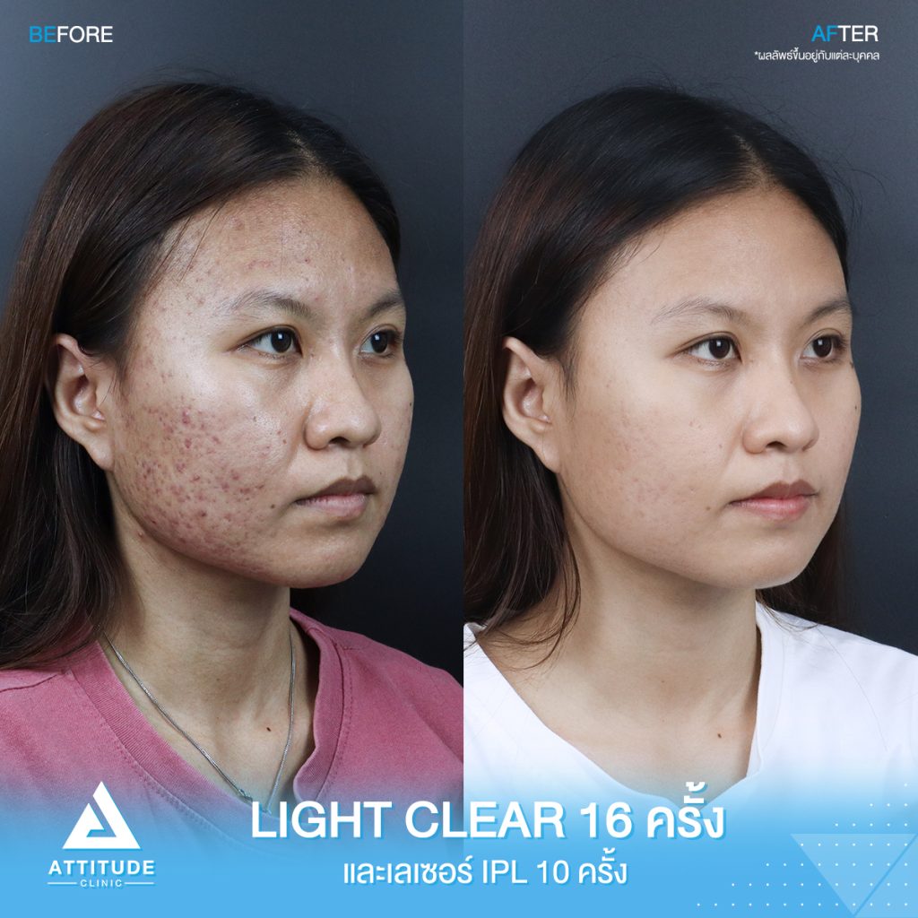 รีวิวรักษาสิว น้องอาย ผู้หญิง รีวิวรักษาสิวครบวงจร น้องอาย โปรแกรม Light Clear 7 ขั้นตอน จำนวน 16 ครั้ง เลเซอร์หน้าใส Cellec V IPL จำนวน 10 ครั้งที่มีปัญหา สิวอุดตัน สิวอักเสบ สิวแพ้ และรอยสิว
