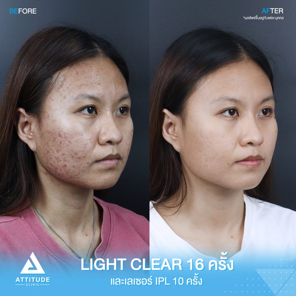 รีวิวรักษาสิวครบวงจร น้องอาย โปรแกรม Light Clear 7 ขั้นตอน จำนวน 16 ครั้ง เลเซอร์หน้าใส Cellec V IPL จำนวน 10 ครั้งที่มีปัญหา สิวอุดตัน สิวอักเสบ สิวแพ้ และรอยสิว