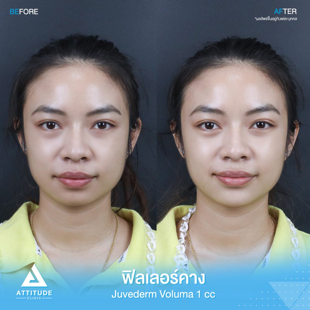 รีวิวฉีดฟิลเลอร์คาง คุณขวัญ Juvederm Voluma จำนวน 1 cc เพิ่มมิติใบหน้าได้สัดส่วนมากขึ้น คางเรียวสวย เป็นธรรมชาติ หันมุมไหนก็มั่นใจ