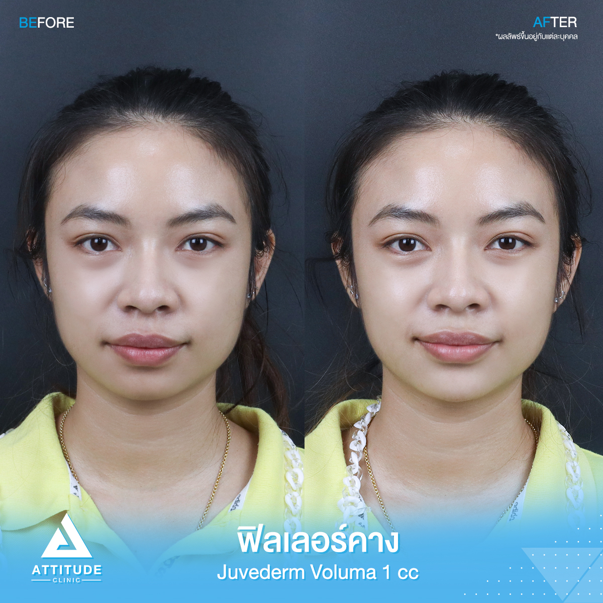 รีวิวฉีดฟิลเลอร์คาง คุณขวัญ Juvederm Voluma จำนวน 1 cc เพิ่มมิติใบหน้าได้สัดส่วนมากขึ้น คางเรียวสวย เป็นธรรมชาติ หันมุมไหนก็มั่นใจ