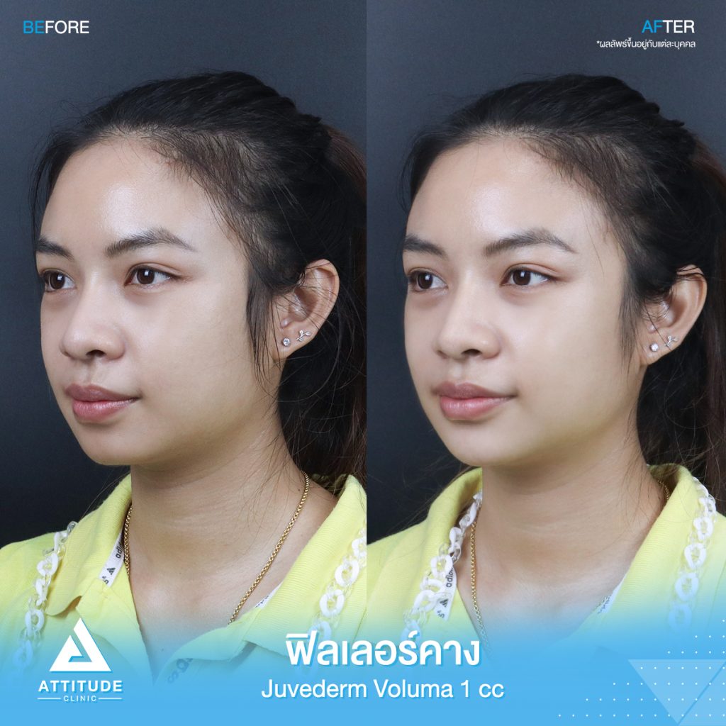 รีวิวฉีดฟิลเลอร์คาง คุณขวัญ Juvederm Voluma จำนวน 1 cc เพิ่มมิติใบหน้าได้สัดส่วนมากขึ้น คางเรียวสวย เป็นธรรมชาติ หันมุมไหนก็มั่นใจ