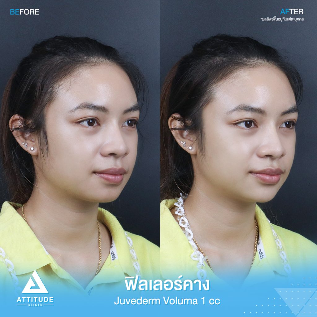 รีวิวฉีดฟิลเลอร์คาง คุณขวัญ Juvederm Voluma จำนวน 1 cc เพิ่มมิติใบหน้าได้สัดส่วนมากขึ้น คางเรียวสวย เป็นธรรมชาติ หันมุมไหนก็มั่นใจ