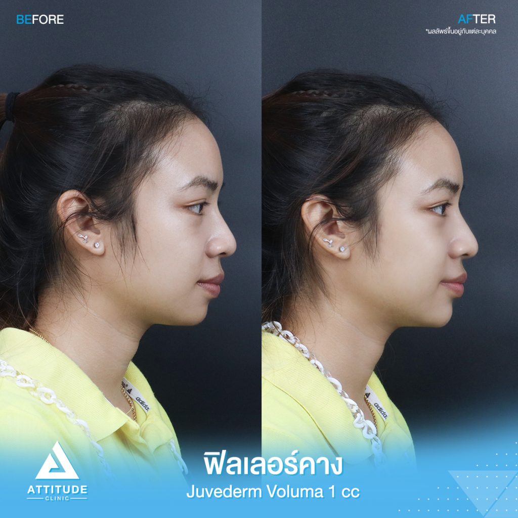 รีวิวฉีดฟิลเลอร์คาง คุณขวัญ Juvederm Voluma จำนวน 1 cc เพิ่มมิติใบหน้าได้สัดส่วนมากขึ้น คางเรียวสวย เป็นธรรมชาติ หันมุมไหนก็มั่นใจ