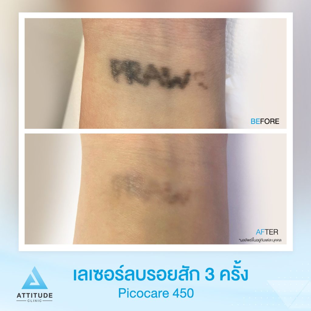 รีวิวลบรอยสักด้วยเครื่อง Picocare 450 (Picosecond Laser)