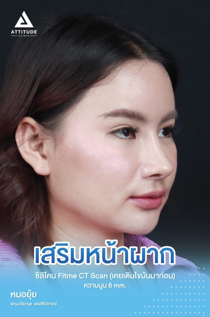 รีวิวเสริมหน้าผากคุณแก๊บ ด้วยซิลิโคน Fitme แบบหล่อเฉพาะบุคคล ความนูน 6mm แก้ปัญหาหน้าผากไม่รับกับจมูกและใบหน้า หน้าผากแบน เพิ่มให้สวยละมุนถาวร โดยคุณหมอยุ้ย