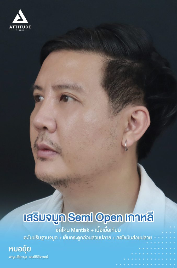 รีวิวเสริมจมูกผู้ชาย คุณวุทธ์ แก้ฐานจมูกฮัมพ์สูง ด้วยซิลิโคน Mantisk ปรับฐานจมูกก่อนวางซิลิโคนโดยคุณหมอยุ้ย เน้นเป็นธรรมชาติ ปลอดภัยถาวร หล่อเป๊ะ ไม่โป๊ะ