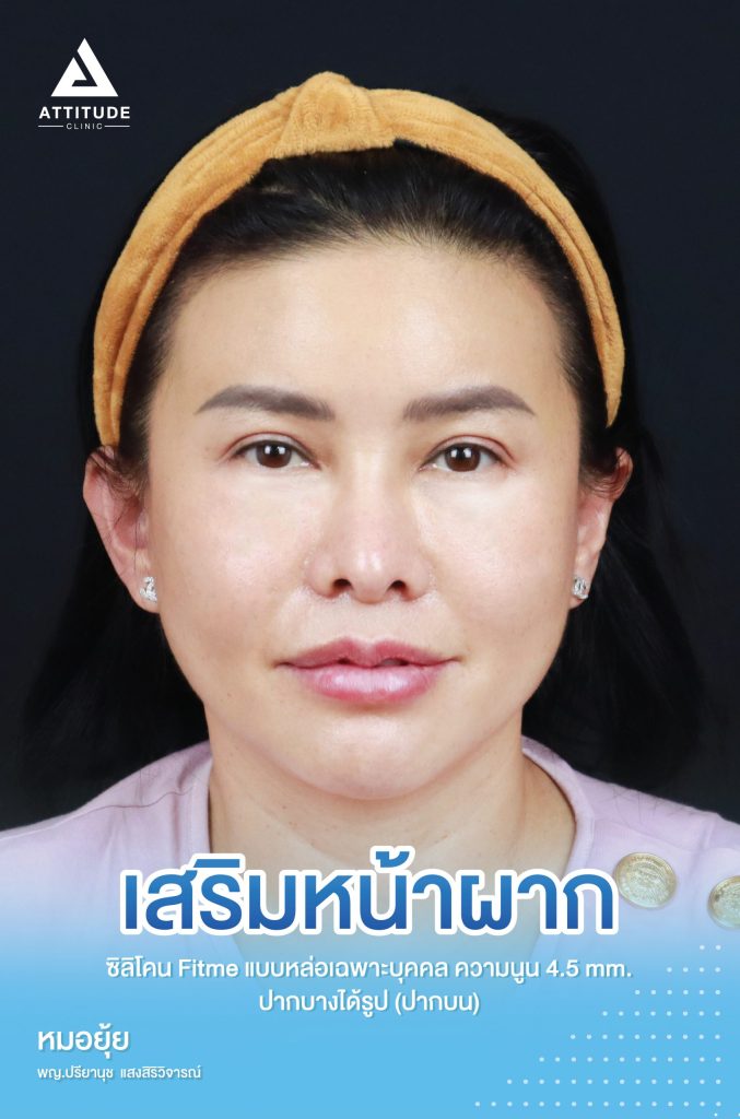 รีวิวเสริมหน้าผาก คุณอุ่น ด้วยซิลิโคน Fitme แบบหล่อเฉพาะบุคคลที่ความนูน 6 mm และปรับทรงปากบนให้บางสวย มีมิติรับกับรูปหน้า โดยคุณหมอยุ้ย