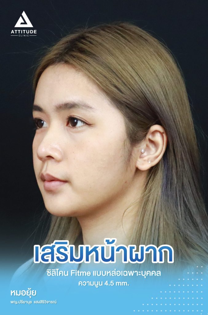 รีวิวเสริมหน้าผากผู้หญิง ซิลิโคน Fitme หล่อเฉพาะบุคคล เติมเต็มปรับทรงหน้าผาก สวยละมุน เป็นธรรมชาติ ไม่โหนกนูนเกินไป โดยคุณหมอยุ้ย