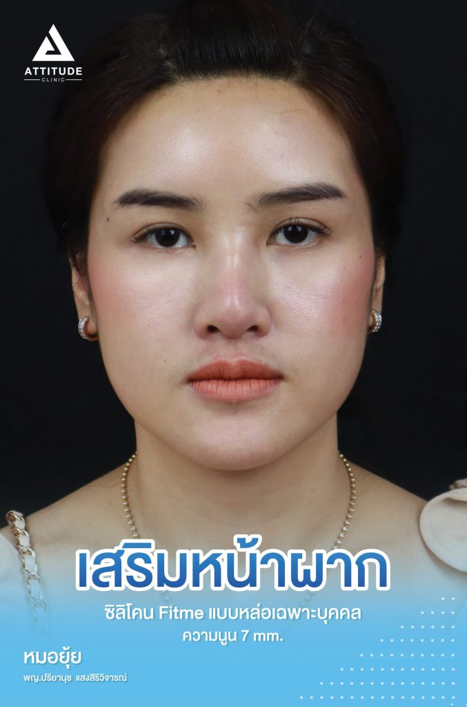 รีวิวเสริมหน้าผาก คุณแจน ด้วยซิลิโคน Fitme แบบหล่อเฉพาะบุคคล แก้ปัญหาโหนกคิ้วสูง ตรงกลางนูนไม่เสมอกัน เสริมด้วยความนูนพอดี รับกับรูปหน้า สวยหวาน ไม่โป๊ะ