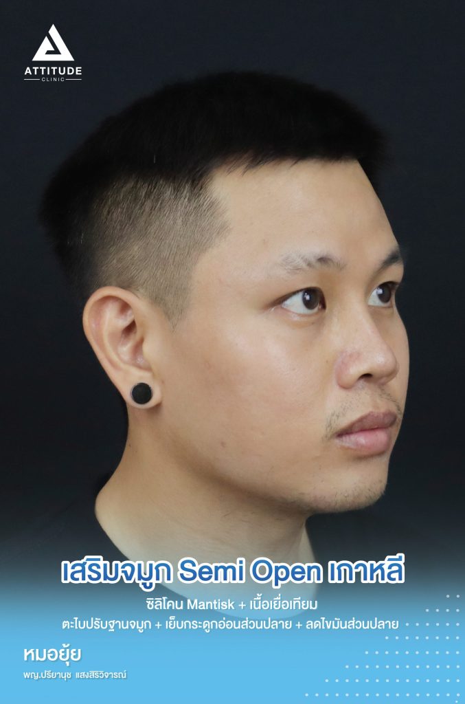 รีวิวเสริมจมูกผู้ชาย คุณเนส เคสเนื้อน้อย ด้วยซิลิโคน Mantisk เทคนิค Semi Open เกาหลี ตะไบปรับฐานจมูก เย็บกระดูกอ่อนส่วนปลาย เพิ่มมิติ ทรงผู้ชาย หล่อปลอดภัยเป็นธรรมชาติ โดยคุณหมอยุ้ย