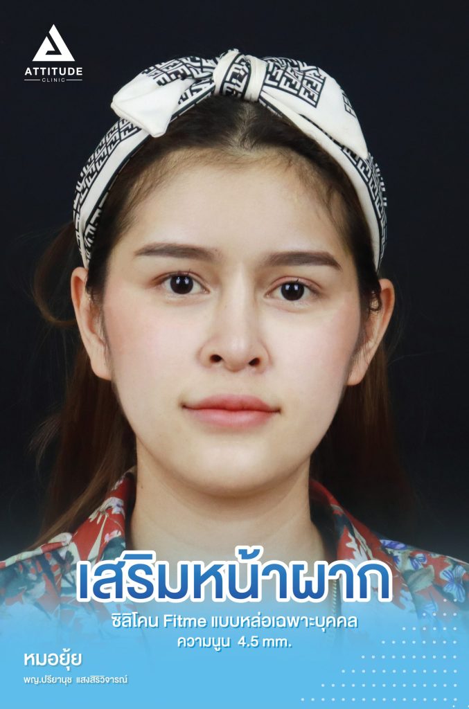 รีวิวเสริมหน้าผาก ด้วยซิลิโคน Fitme แบบหล่อเฉพาะบุคคล แก้ปัญหาหน้าผากแคบ หน้าผากไม่เรียบ เติมเต็มเพิ่มมิติให้สวย แบบถาวร โดยคุณหมอยุ้ย