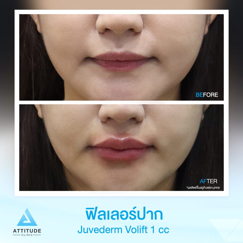 รีวิวฉีดฟิลเลอร์ปาก Juvederm Volift จำนวน 1 cc เติมเต็มปากให้อวบอิ่ม เพิ่มความละมุน เป็นธรรมชาติเข้ากับรูปหน้า หันมุมไหนก็มั่นใจสุดๆ