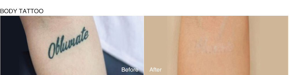 รีวิวลบรอยสักด้วยเครื่อง Picocare 450 (Picosecond Laser)