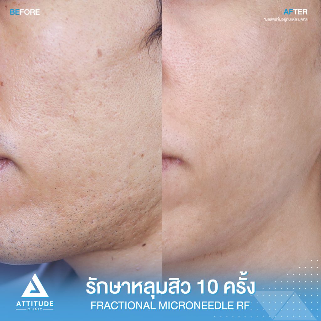 รีวิวรักษาหลุมสิว Fractional Micro Needle RF จำนวน 10 ครั้ง หลุมสิวตื้นขึ้น ผิวหน้าแน่นฟู รูขุมขนกระชับ