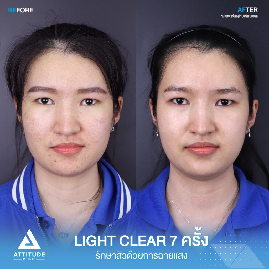 รีวิวรักษาสิวครบวงจร โปรแกรม Light Clear 7 ขั้นตอน จำนวน 7 ครั้ง ลูกค้ามีปัญหาสิวและรอยสิว หลังรักษาสิวตอนนี้หน้าใสวิ้ง ผิวเรียบเนียนมั่นใจสุดๆ