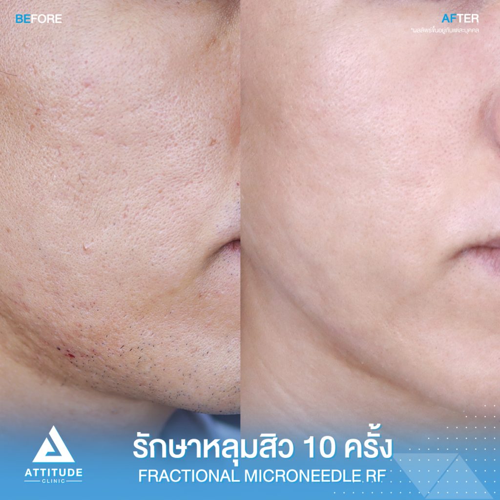 รีวิวรักษาหลุมสิว Fractional Micro Needle RF จำนวน 10 ครั้ง หลุมสิวตื้นขึ้น ผิวหน้าแน่นฟู รูขุมขนกระชับ