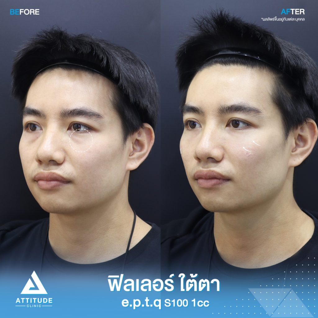 รีวิวฉีดฟิลเลอร์ใต้ตา e.p.t.q. S100 จำนวน 1 cc เติมเต็มร่องใต้ตา แก้ไขใต้ตาคล้ำ ให้อิ่มฟูสดใส เรียบเนียนเป็นธรรมชาติที่ Attitude Clinic