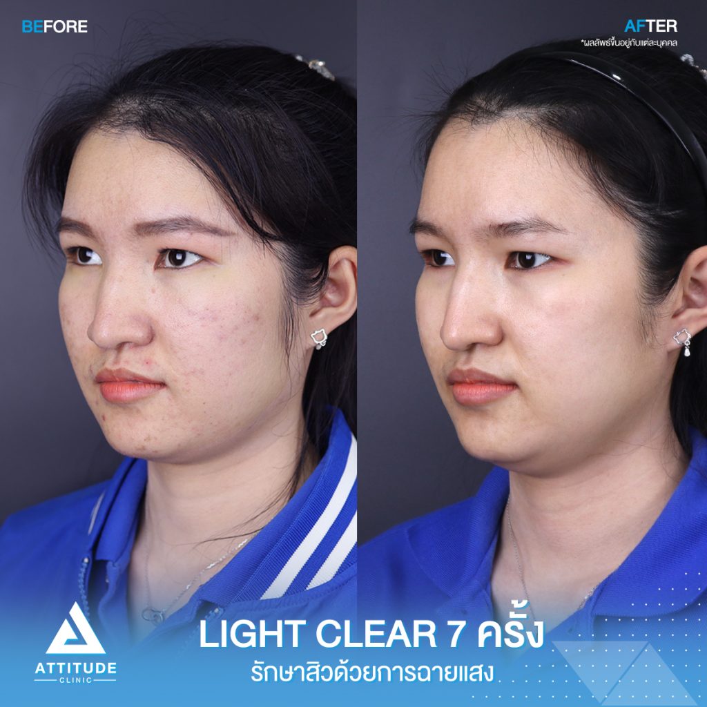 รีวิวรักษาสิวครบวงจร โปรแกรม Light Clear 7 ขั้นตอน จำนวน 7 ครั้ง ลูกค้ามีปัญหาสิวและรอยสิว หลังรักษาสิวตอนนี้หน้าใสวิ้ง ผิวเรียบเนียนมั่นใจสุดๆ