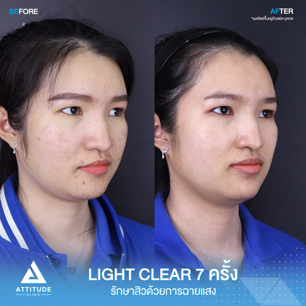 รีวิวรักษาสิวครบวงจร โปรแกรม Light Clear 7 ขั้นตอน จำนวน 7 ครั้ง ลูกค้ามีปัญหาสิวและรอยสิว หลังรักษาสิวตอนนี้หน้าใสวิ้ง ผิวเรียบเนียนมั่นใจสุดๆ