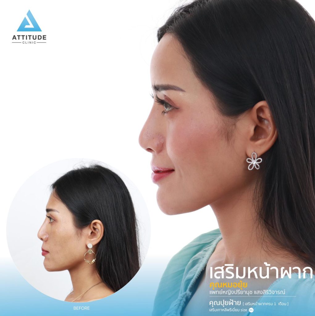 รีวิวเสริมหน้าผาก