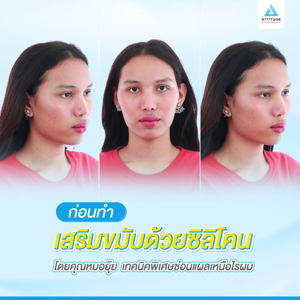 รูปรีวิวเสริมขมับด้วยซิลิโคน