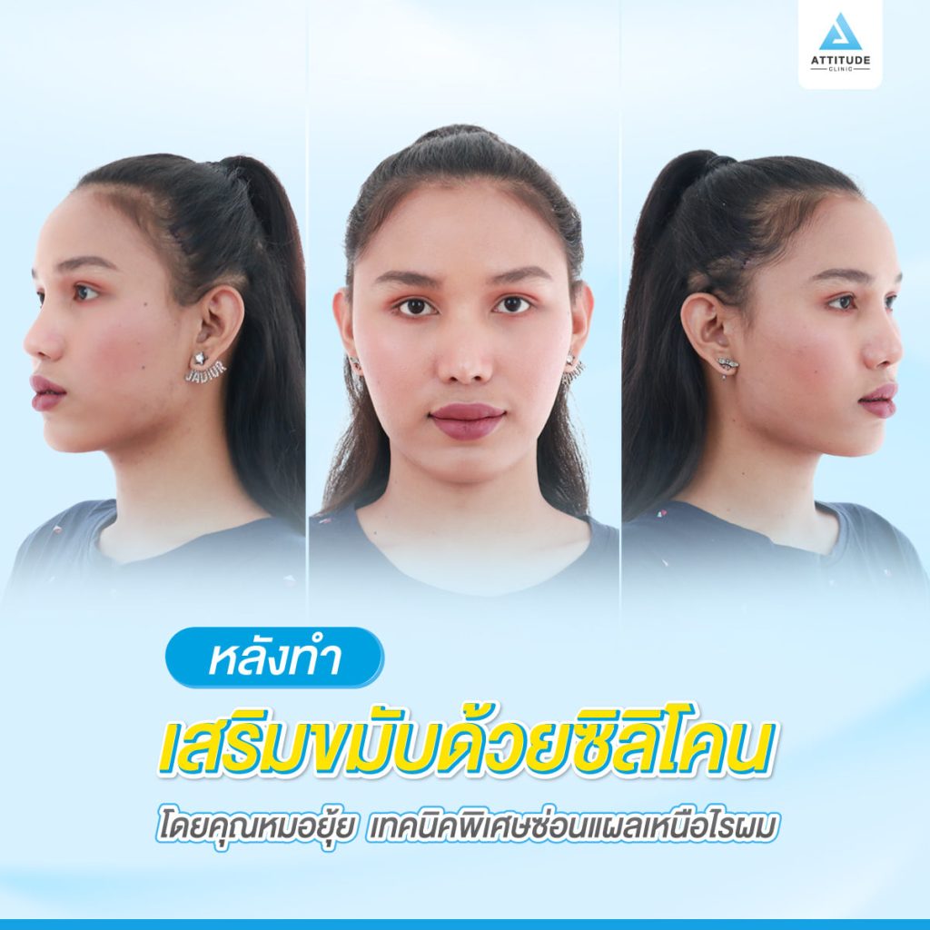 รูปรีวิวเสริมขมับด้วยซิลิโคน