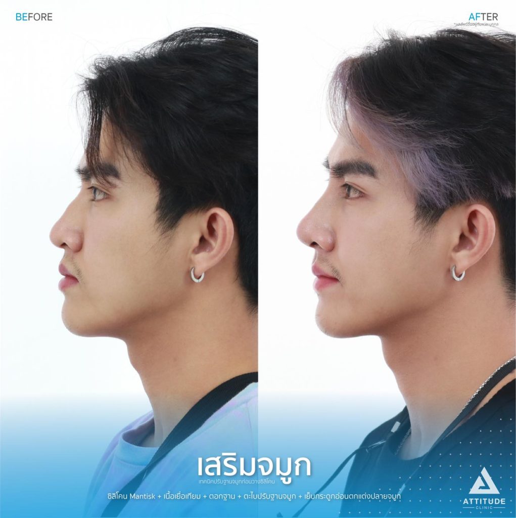 รีวิวเสริมจมูกผู้ชาย ทรงธรรมชาติ ไม่โป๊ะ ฝีมือหมอยุ้ย Attitude Clinic รัชดา