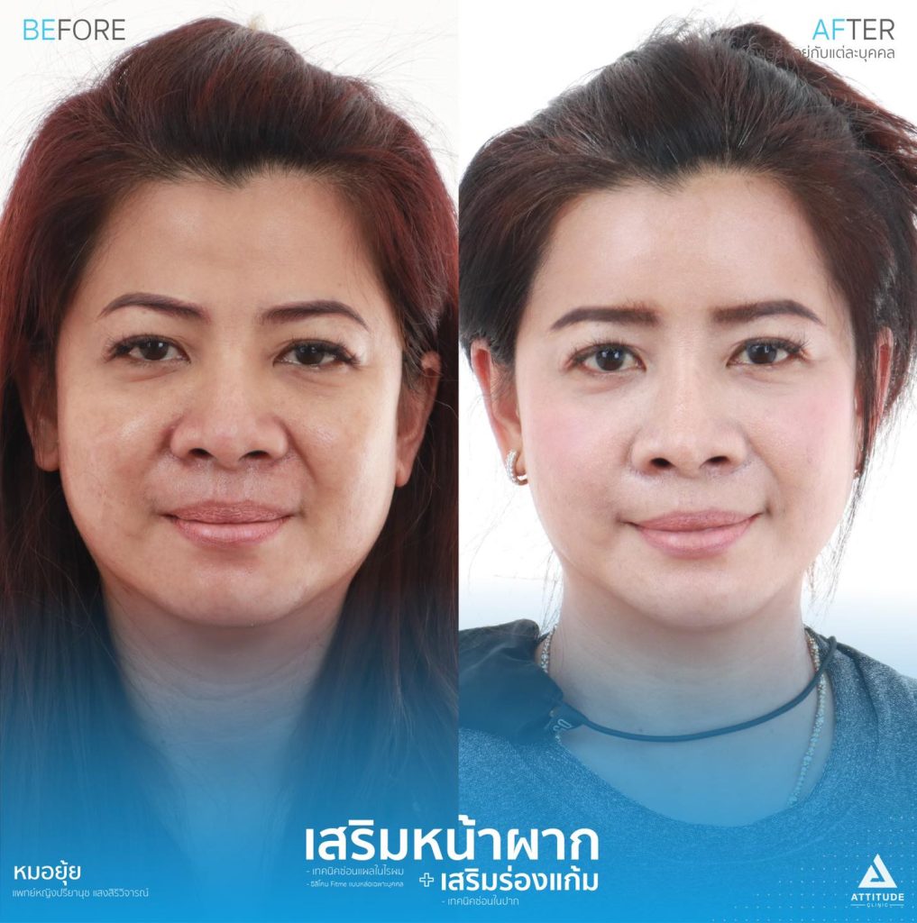 รีวิวเสริมร่องแก้มด้วยซิลิโคน